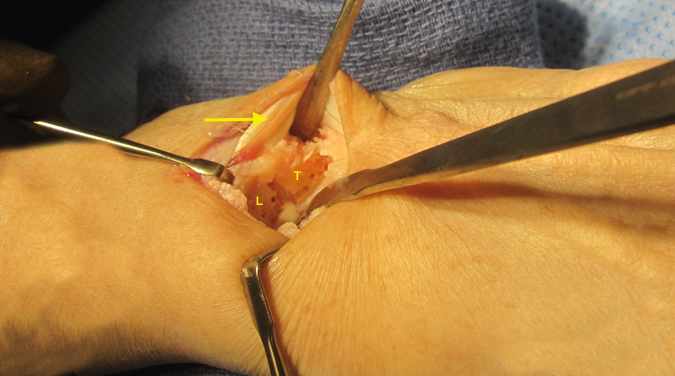 SNAC Wrist showing lunate and triquetrum being prepared for arthrodesis