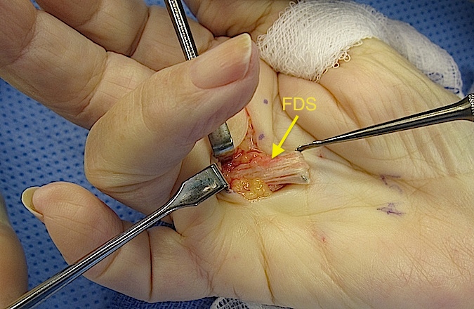 Probe pulling FDS. Note erosions on FDS and tenosynovium evading tendon substance. PIP joint passively flexing after A-1 release.