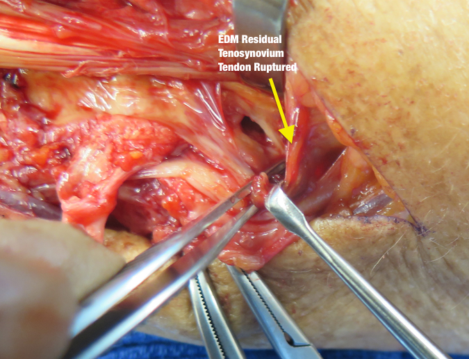 EDM Synovial Sheath with no Tendon