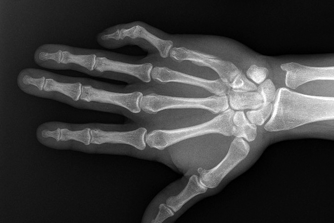 Fifth metacarpal spiral shaft fracture with non displaced butterfly fragment treated with a cast.  Note callus and remodeling.