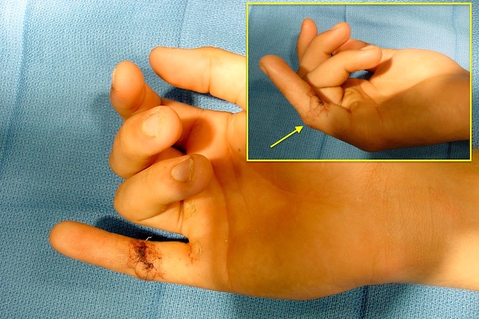 Right little finger FDP laceration with probable intact or partially intact FDS (arrow)