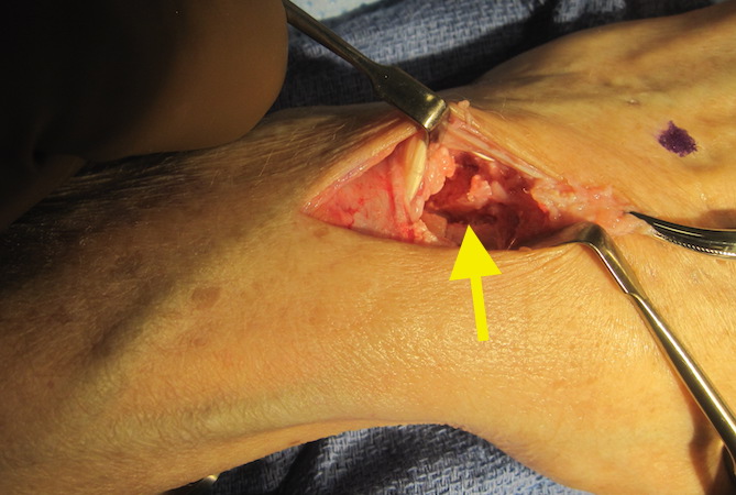 SNAC Wrist showing 4-corner fusion area before grafting