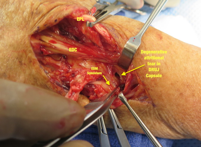 Attritional defect in DRUJ Capsule which allowed arthritic ulnar head to rupture the extensor tendons( EDM, EDC V , EDC IV and partially rupture EDC III)