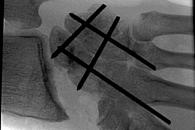 SNAC Wrist AP X-ray showing 4-corner fusion area after grafting and internal fixation with .62 K-wires.
