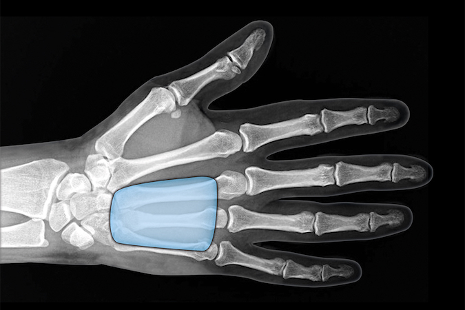 The midpalmar space is a potential space between the volar interosseous fascia, the flexor sheath, the oblique and hypothenar septum. Infection is usually secondary to spread of infection from flexor sheath of long and ring fingers.