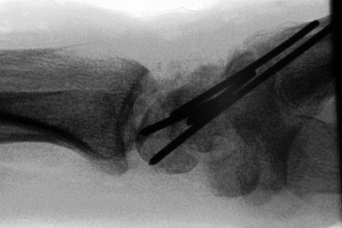 SNAC Wrist Lateral X-ray showing 4-corner fusion area after grafting and internal fixation with .62 K-wires.