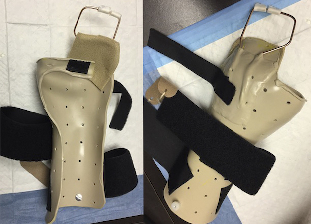 Dynamic extension splint used with a ring splint for A-2 pulley reconstruction rehabilitation.