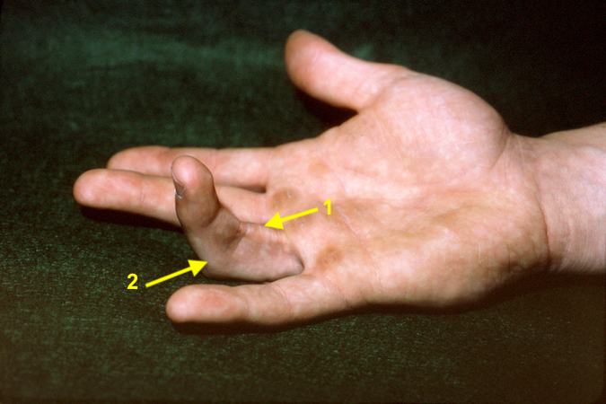 Chronic A-2 pulley rupture right ring finger with marked displaced flexor tendon (1) and PIP joint flexion contracture (2).