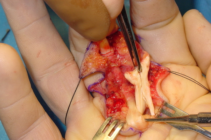 Right long finger pulley reconstruction. Note joint an FDS release. FDS will be used to construct pulley (no PL available). Some A-3 pulley intact.