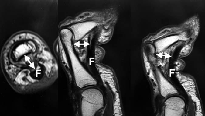 MRI of an A-2 pulley rupture. Note the marked palmar displacement (arrow) of the flexor tendons (F). 