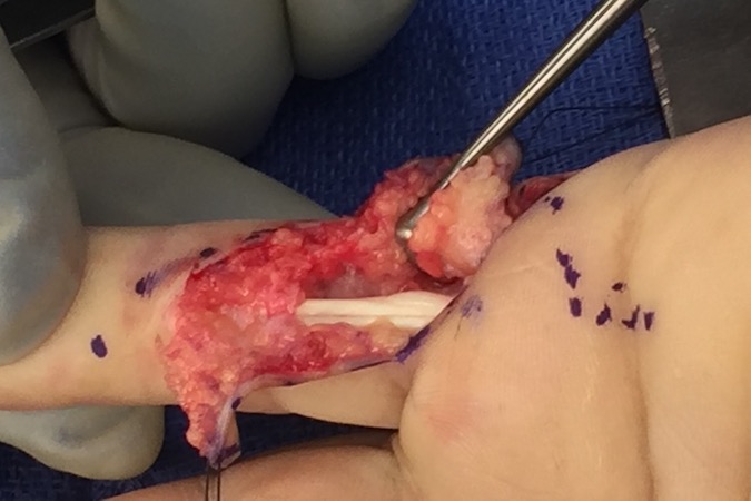 Flexor tendons exposed. Note complete lack of flexor tendon sheath (A-2 pulley).
