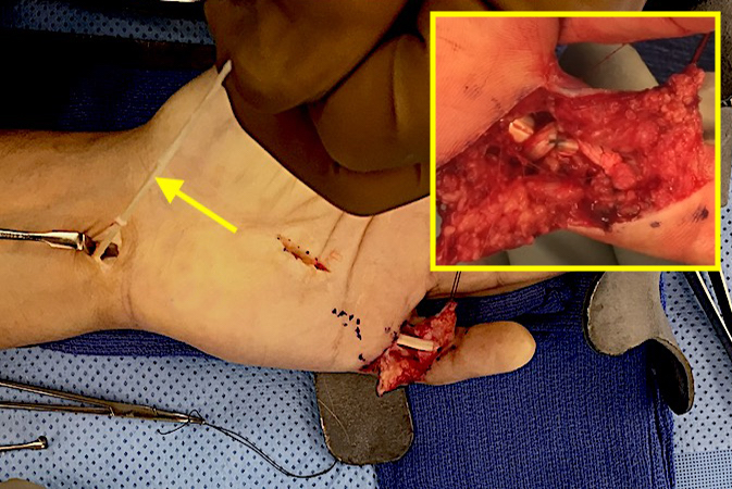 FDS being harvested (arrow) and completed repair (Insert).