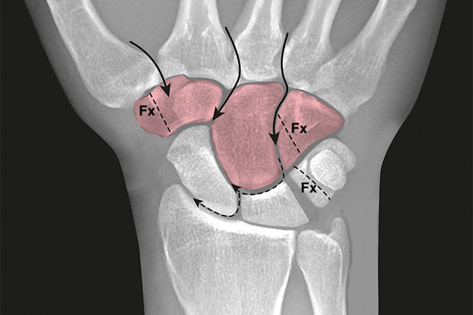 Axial carpal fracture and dislocation pathways (ref 17) superimposed on normal PA x-ray.  Axial carpal fracture (Fx) and dislocation injuries usually disrupt the distal carpal row and metacarpal arch and can occasionally be associated with perilunate dislocations.