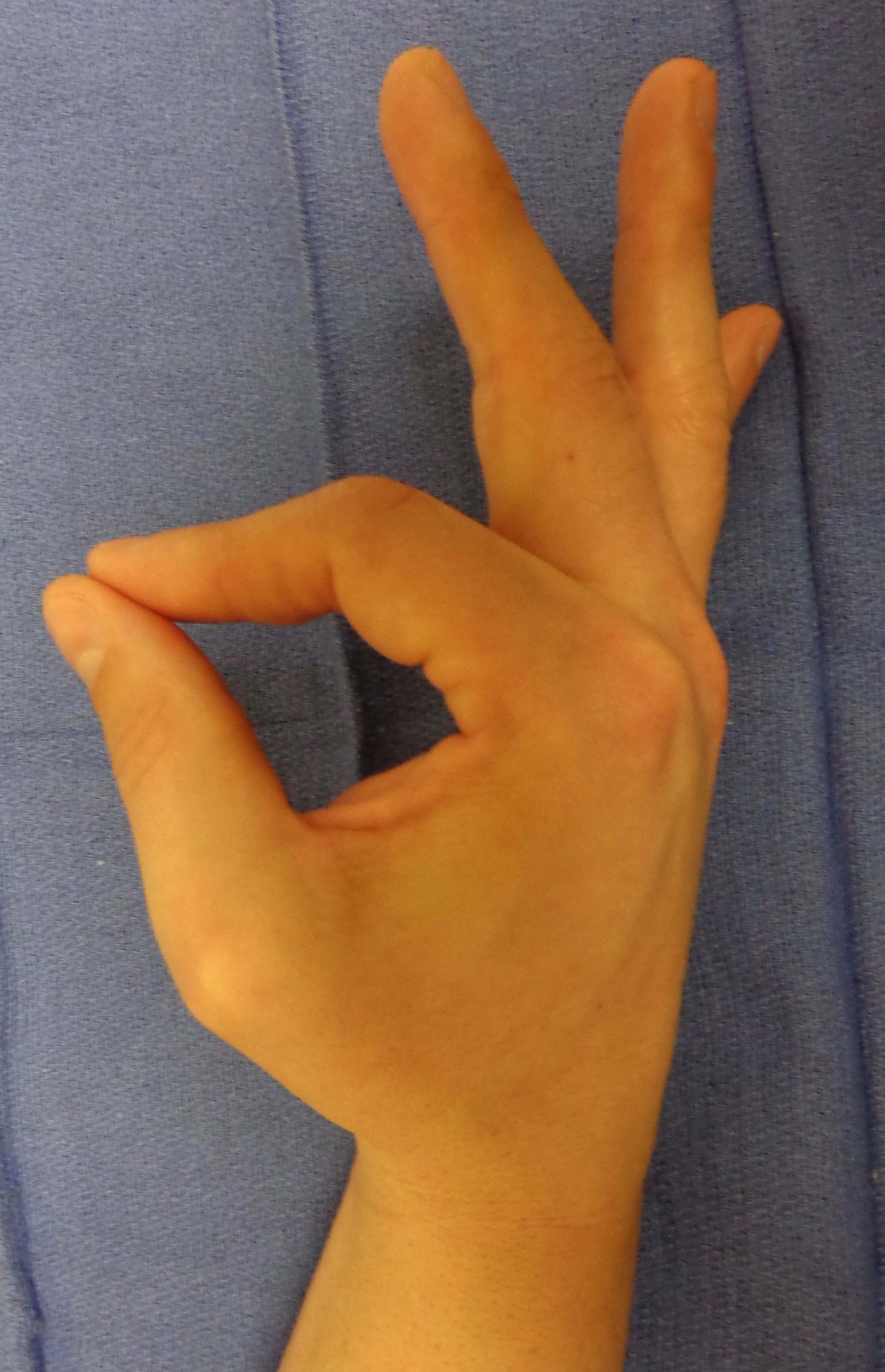 AIN Palsy Sign with absent index DIP and thumb IP flexion