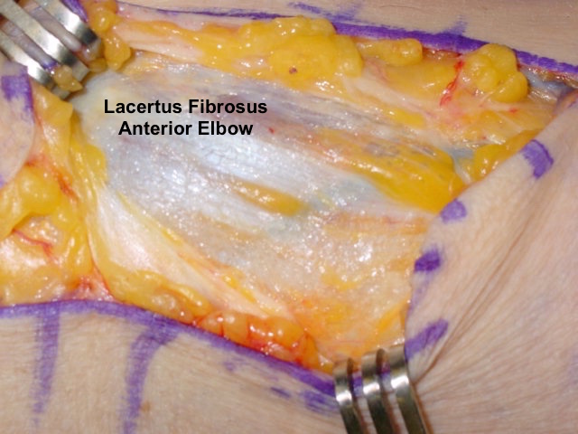 Anterior elbow incision has exposed the lacertus fibrosus