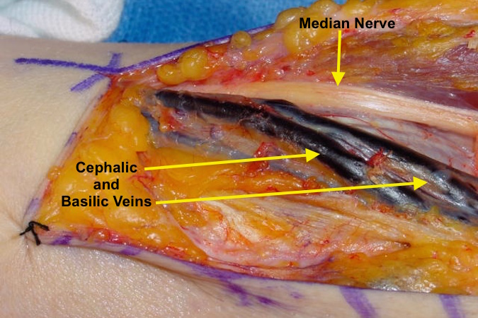The lacertus fibrosis has been open exposing the cephalic vein, basilic vein and the median nerve.