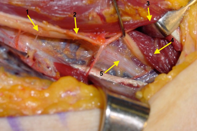 The dissection has moved deeper exposing: 1. Median Nerve, 2. Median Nerve branch to the Pronator Teres, 3. retracted Pronator Teres, 4. Flexor Digitorum Superficialis muscle after transection of the fascial sling, 5. Anterior Interosseous Nerve with color change from compression.