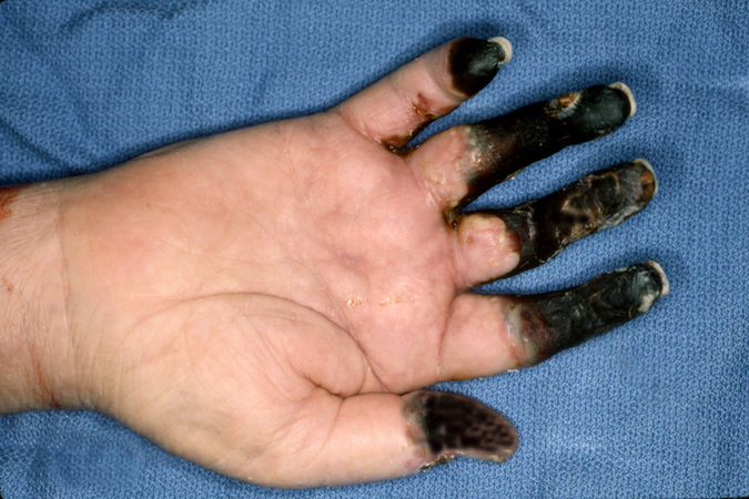 Right thumb and finger necrosis after severe frostbite injury