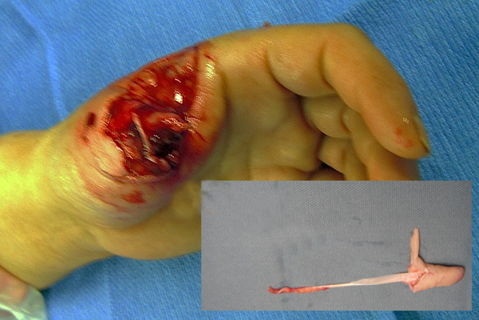 Left thumb amputation with avulsion component not acceptable for replantation