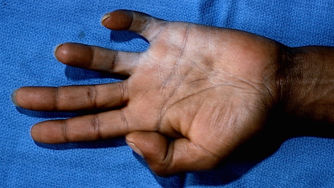 Ulnar Nerve Palsy with clawing of the fourth and fifth fingers and marked dryness of the ulnar denervated skin (anhydrous )
