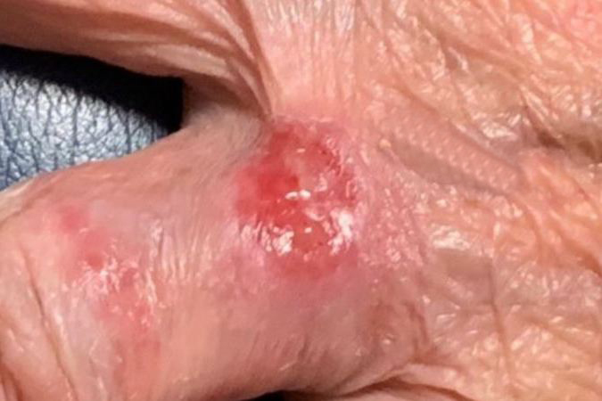 Basal cell carcinoma on the dorsal base of the left ring finger.