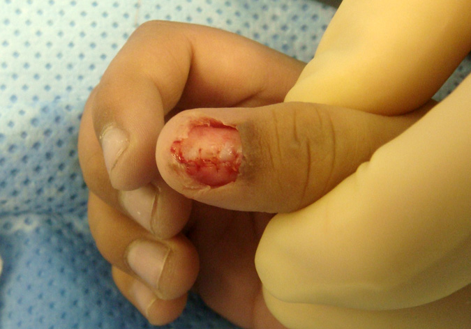 Blue Nevus Thumb Nail-Sterile matrix repair and germinal matrix preserved