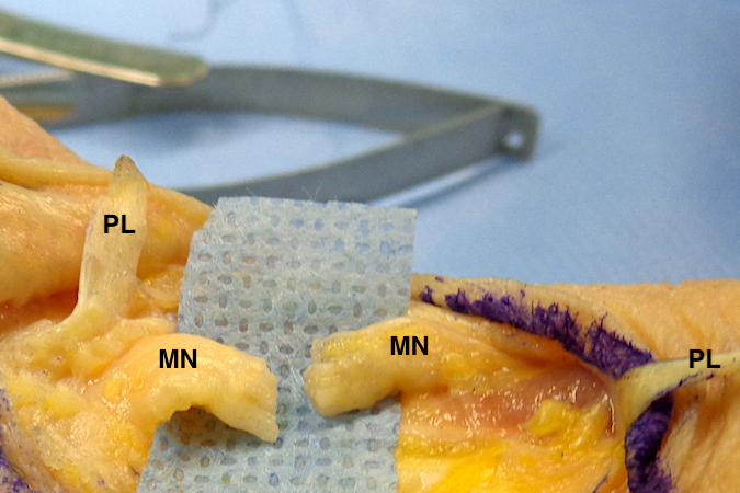 Laceration Median Nerve (MN) in an anatomic specimen.  Palmaris longus (PL) also visible.