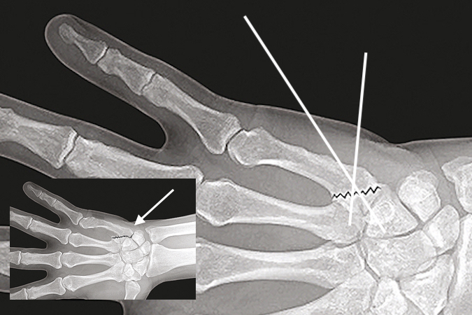 Fifth metacarpal displaced intra-articular "Baby Bennett's" fracture after closed reduction and percutaneous pinning.