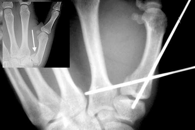 Bennett's fracture (arrow) treated with closed reduction and percutaneous pinning with slight residual joint incongruity.
