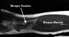 2.	This MRI (T1) image of the biceps is a coronal view.  The biceps muscle is visible, and the retracted curled up and ruptured biceps tendon is seen at the level of the elbow.  