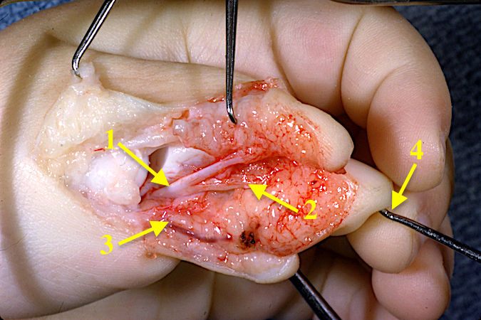 Bifid Thumb Right ( Wassel IV) palmar view. Note split FPL (1) and FPL to ulnar thumb which will be reinforced by transfer of the radial FPL to insertion (2). Note preserved radial neurovascular bundle (3) and skin hook (4) stabilizing radial thumb.