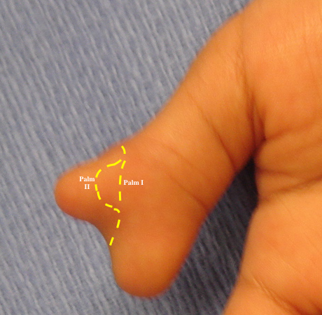 Bifid Thumb (Wassel 2) with palmar (I&II) incisions outlined. The larger palmar flap II on the radial thumb can fold dorsally and distally into the defect created by removal of the radial thumb. Alternatively palmar I can be used and the defect filled completely by the dorsal flap.