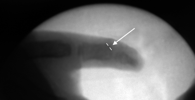 Bifid Thumb Right ( Wassel II) post AP with shaved metacarpal head (arrow)