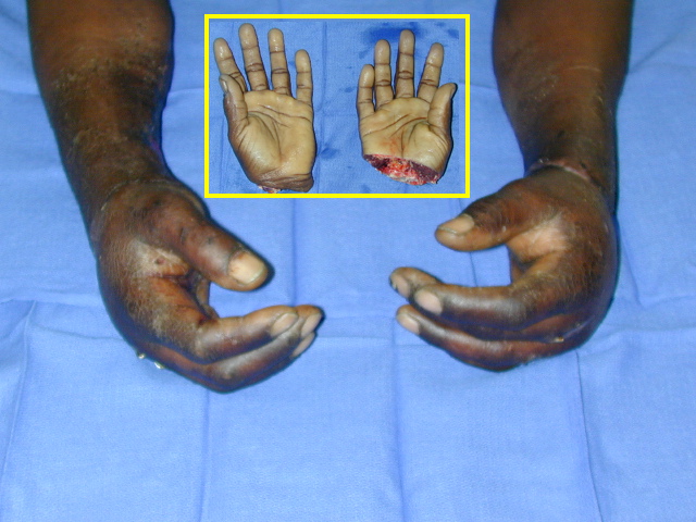 Successful microsurgical replantations of bilateral hand amputation.