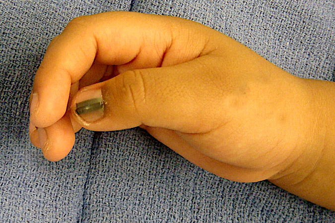 Blue Nevus Thumb Nail