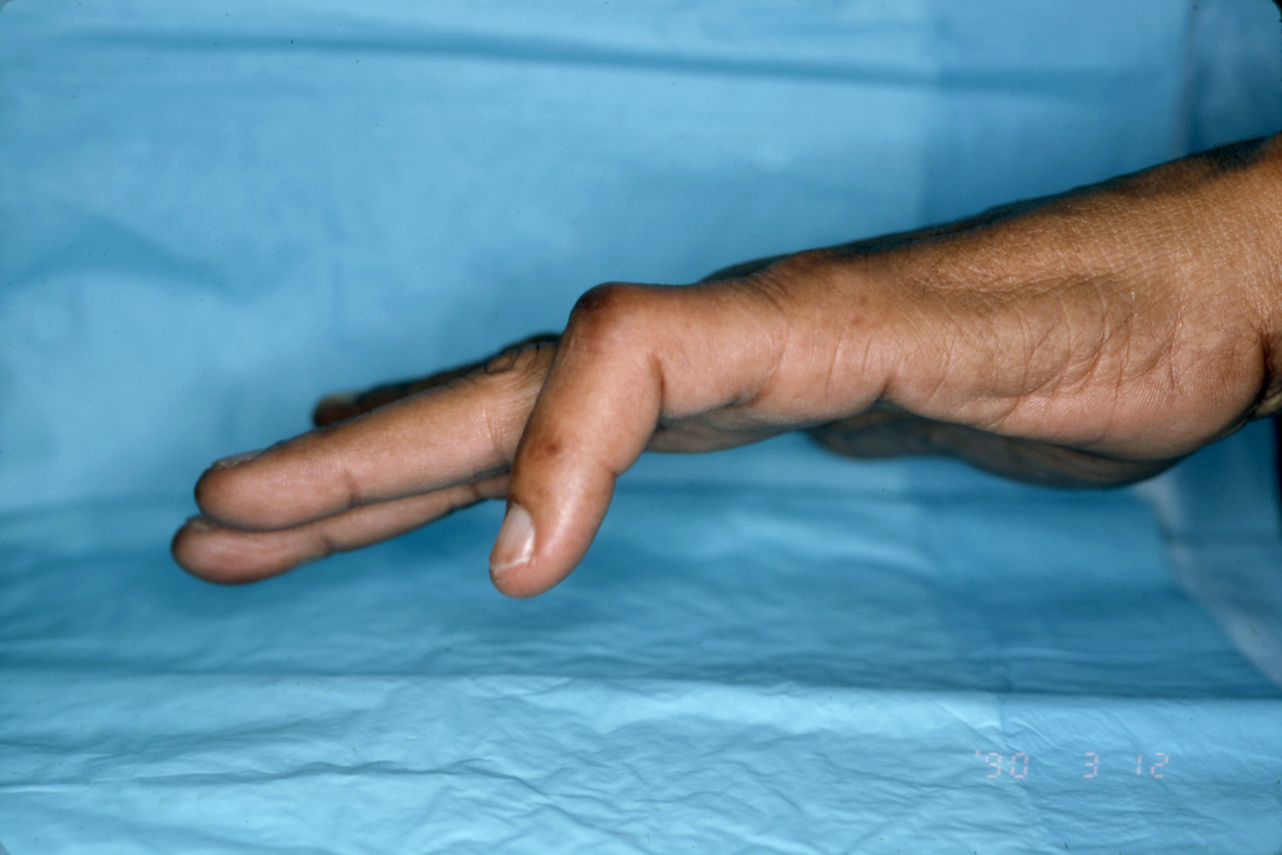BOUTONNIERE DEFORMITY Hand Surgery Resource