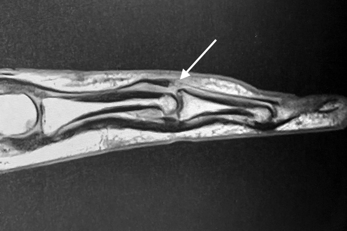 T1-weighted MRI sagittal image of an acute boutonniere.  Note torn and retracted central slip (arrow).