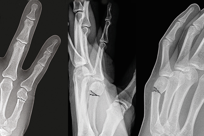 Fifth metacarpal neck fracture (Boxer Fracture) AP, Lateral & oblique with dorsal apex angulation