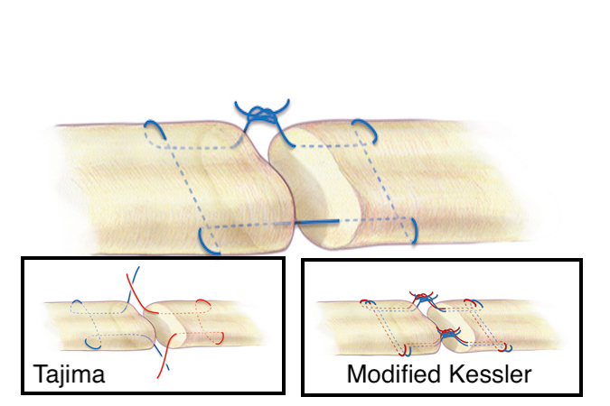 A Kessler core suture (Tajima & Modified Kessler in inserts) for flexor tendon repair. A 3-O or 4-O braided synthetic permanent suture is one acceptable suture choice for the the core suture