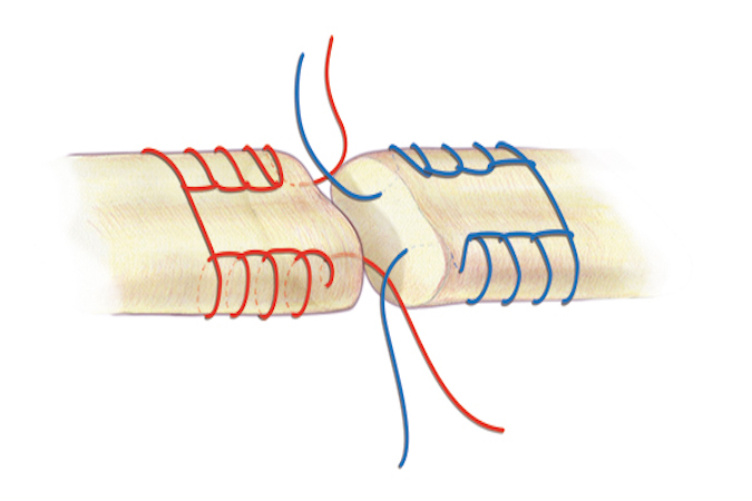 A Krachow core suture for flexor tendon repair. Usually for large tendons like the biceps but possibly useful for a FCR laceration. A 3-O or 4-O braided synthetic permanent suture is one acceptable suture choice for the the core suture