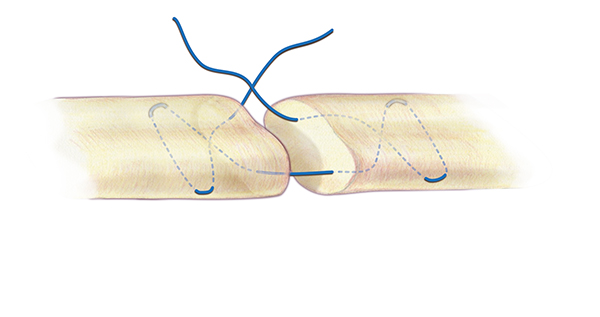 A Modified Bunnell core suture for flexor tendon repair. A 3-O or 4-O braided synthetic permanent suture is one acceptable suture choice for the the core suture