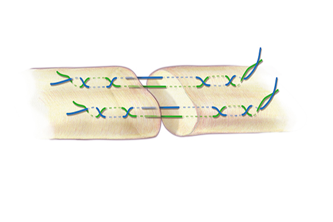 A Savage core suture for flexor tendon repair. A 3-O or 4-O braided synthetic permanent suture is one acceptable suture choice for the the core suture