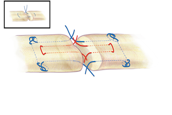 A Strickland core suture for flexor tendon repair. A 3-O or 4-O braided synthetic permanent suture is one acceptable suture choice for the the core suture