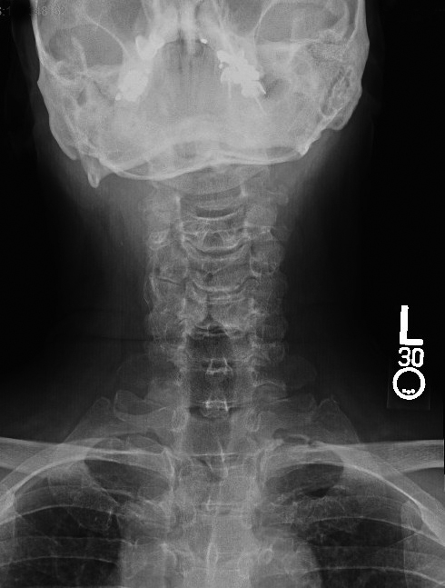 Cervical Osteoarthritis and disc space narrowing AP view