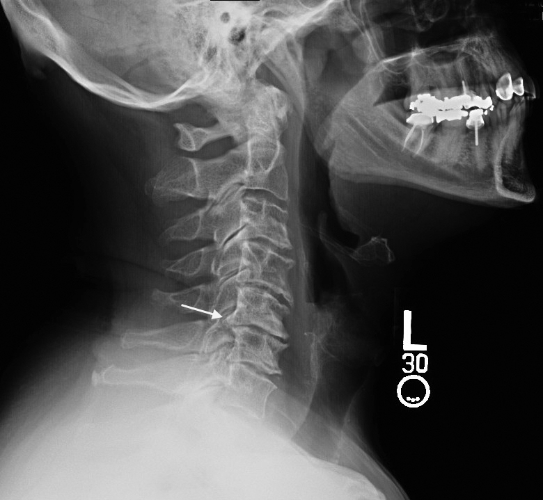 Cervical Osteoarthritis with anterior osteophytes (1), narrow disk space (2) and posterior osteophytes (arrow)