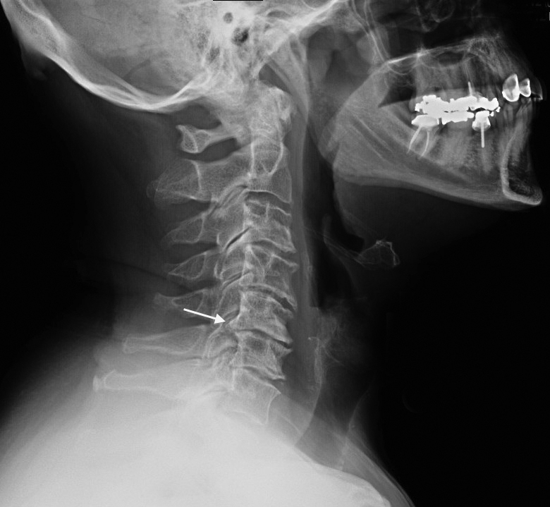 Cervical Arthritis is a common proximal component in Double Crush Syndrome.  See root impingement at the arrow.