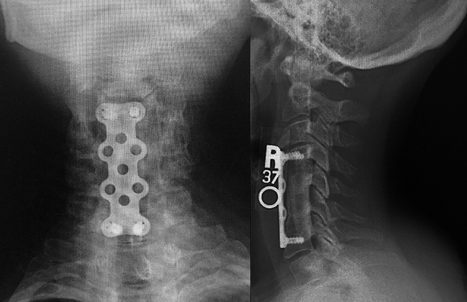 Cervical fusion for multiple level cervical disk space infection secondary to bacteremia from infected A-V malformation finger ulcers.