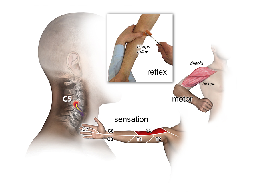 Motor, sensory and biceps reflex exam for C5 Root