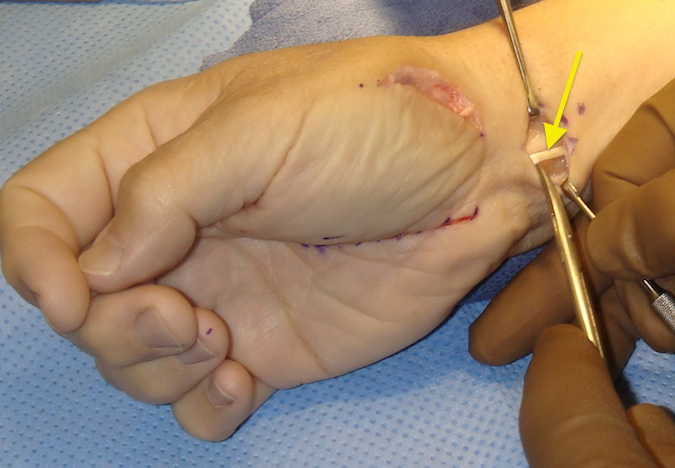 CMC OA Fascial Arthroplasty Palmaris Longus Graft