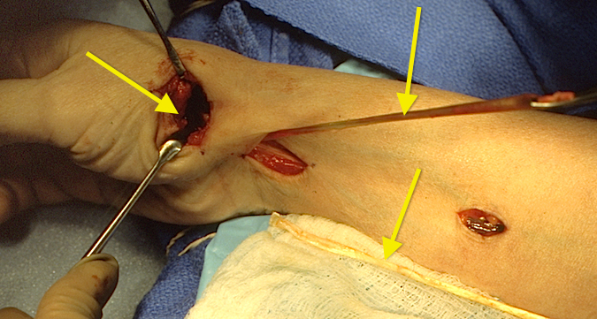 CMC OA Fascial Arthroplasty Palmaris and half FCR